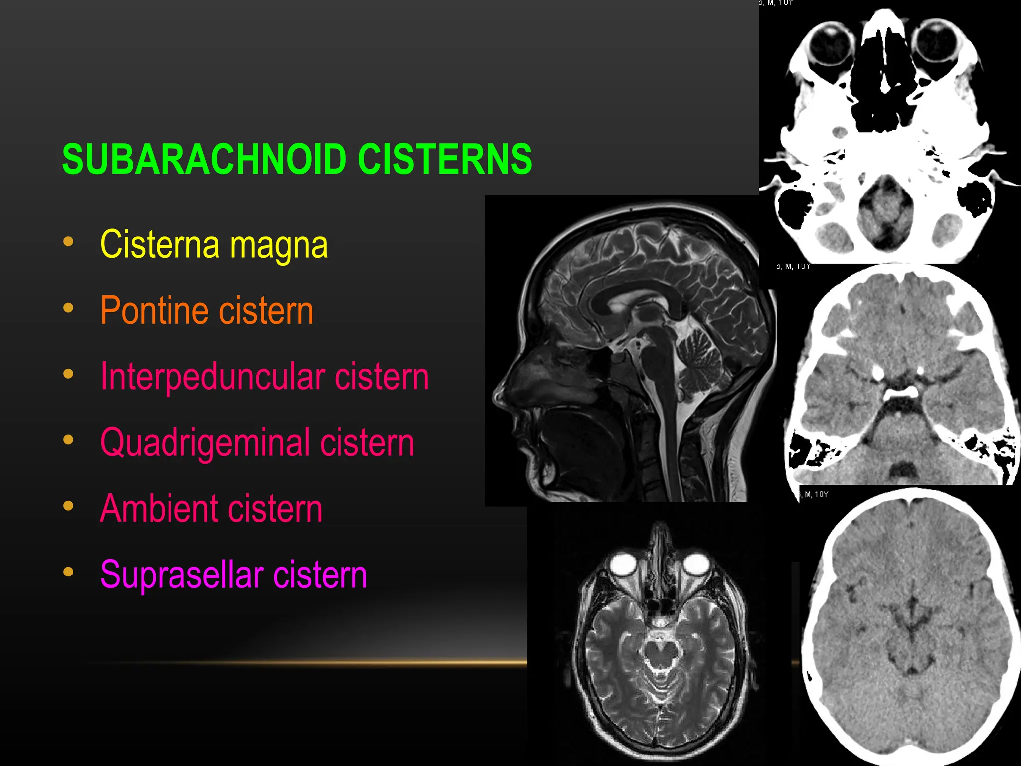 Radiological anatomy of Brain and stroke imaging.ppt