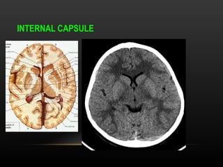 Radiological anatomy of Brain and stroke imaging.ppt