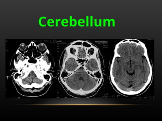 Radiological anatomy of Brain and stroke imaging.ppt