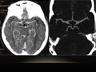Radiological anatomy of Brain and stroke imaging.ppt