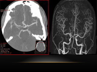 Radiological anatomy of Brain and stroke imaging.ppt