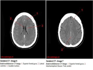 Radiological anatomy of Brain and stroke imaging.ppt