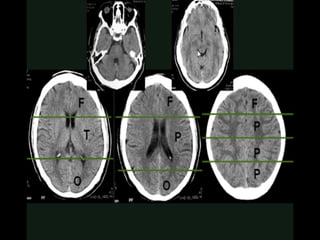 Radiological anatomy of Brain and stroke imaging.ppt