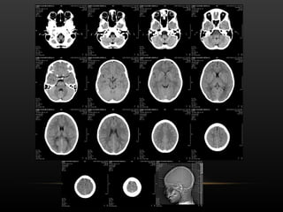 Radiological anatomy of Brain and stroke imaging.ppt