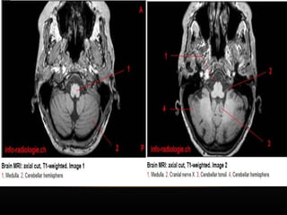 Radiological anatomy of Brain and stroke imaging.ppt