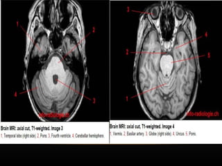 Radiological anatomy of Brain and stroke imaging.ppt