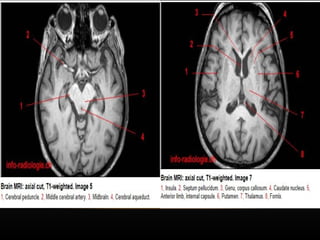 Radiological anatomy of Brain and stroke imaging.ppt