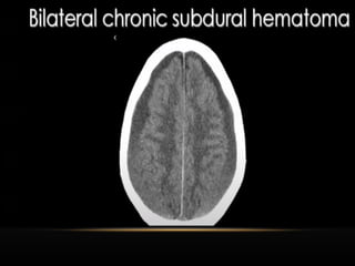Radiological anatomy of Brain and stroke imaging.ppt