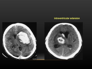 Radiological anatomy of Brain and stroke imaging.ppt