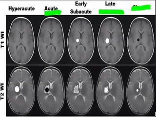 Radiological anatomy of Brain and stroke imaging.ppt