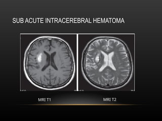 Radiological anatomy of Brain and stroke imaging.ppt
