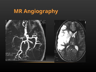 Radiological anatomy of Brain and stroke imaging.ppt