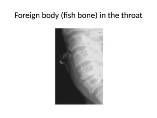 Fish Bone Neck Radiograph Radiology Of Central Nervous System.pptx