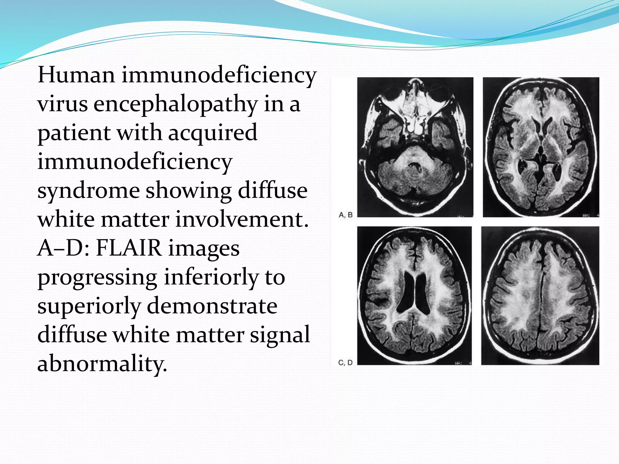 Radiology of demyelinating diseases | PPTX