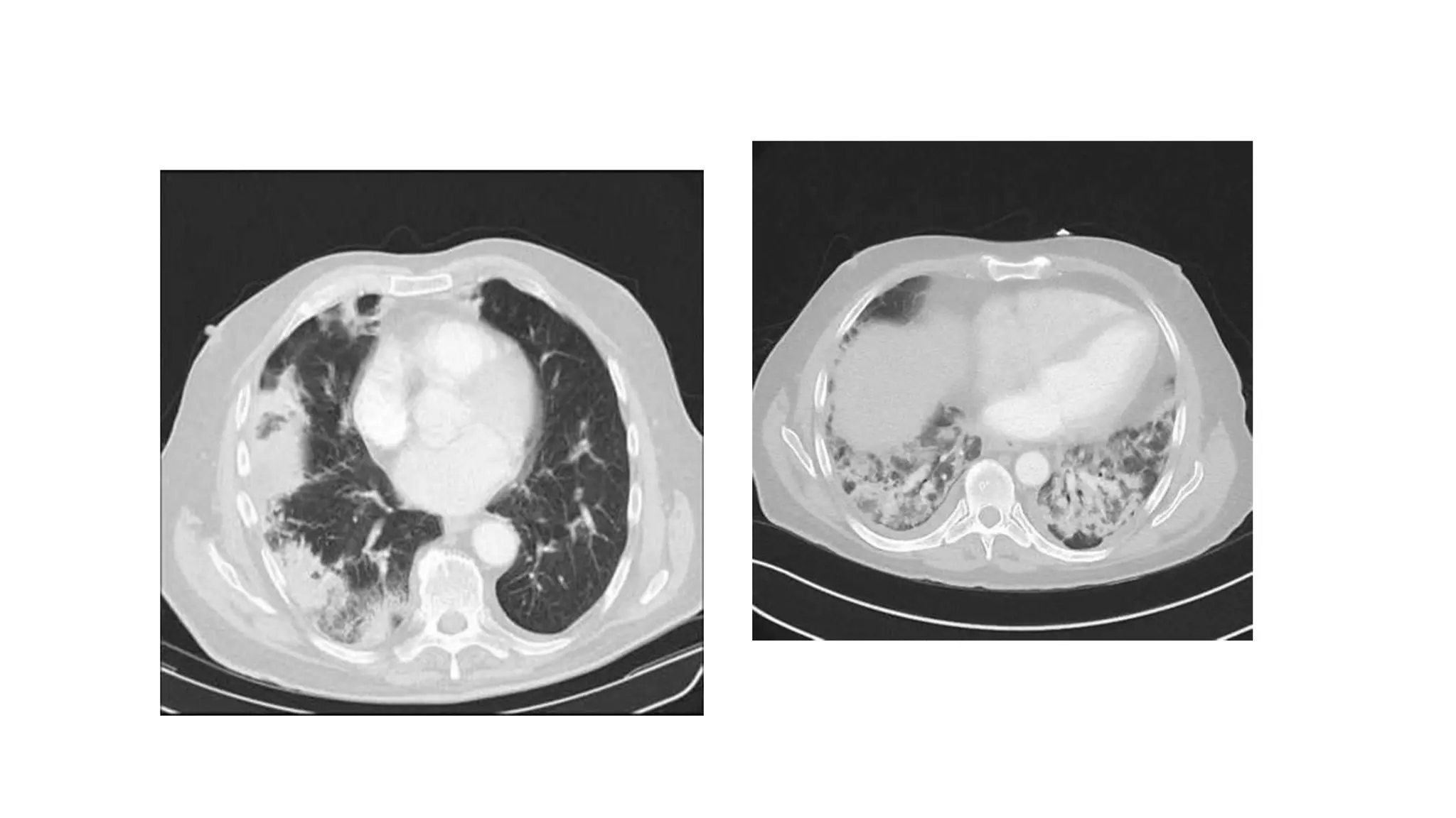 RADIOLOGY OF ILD.pptx