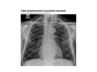 Main Line Imaging RADIOLOGY OF LINES AND TUBES IN INTENSIVE CARE SEMINAR.pdf