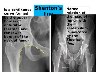 Shenton Line Radiology of lower limb for Pgs and Ugs.pdf