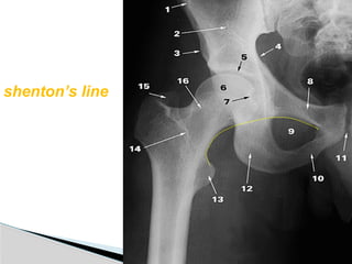 Shenton Line RADIOLOGY OF LOWER LIMB - Anatomy .pptx