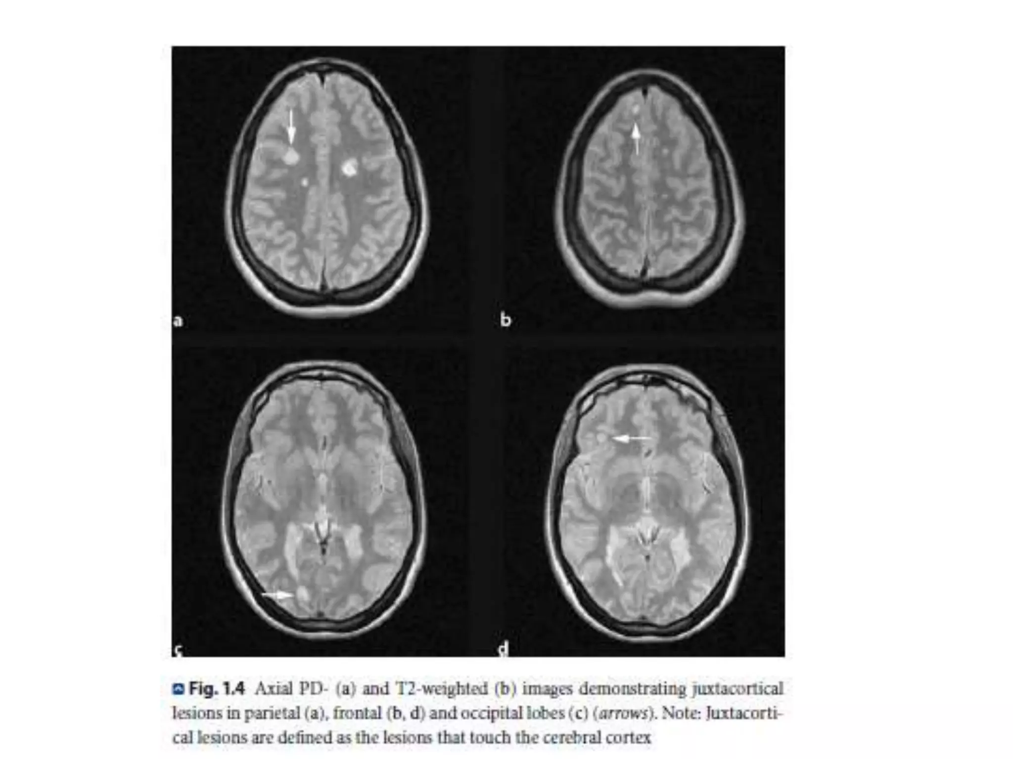 Radiology of MULTIPLE SCLEROSIS | PPTX