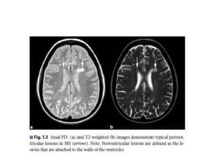 Radiology of MULTIPLE SCLEROSIS | PPTX
