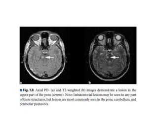 Radiology of MULTIPLE SCLEROSIS | PPTX