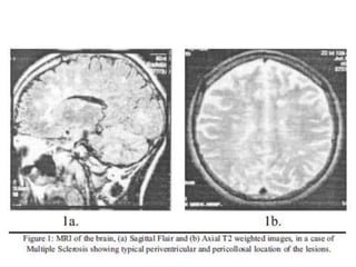 Radiology of MULTIPLE SCLEROSIS | PPTX