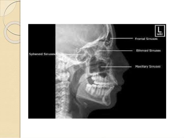 Radiology Of Nose And Paranasal Sinuses