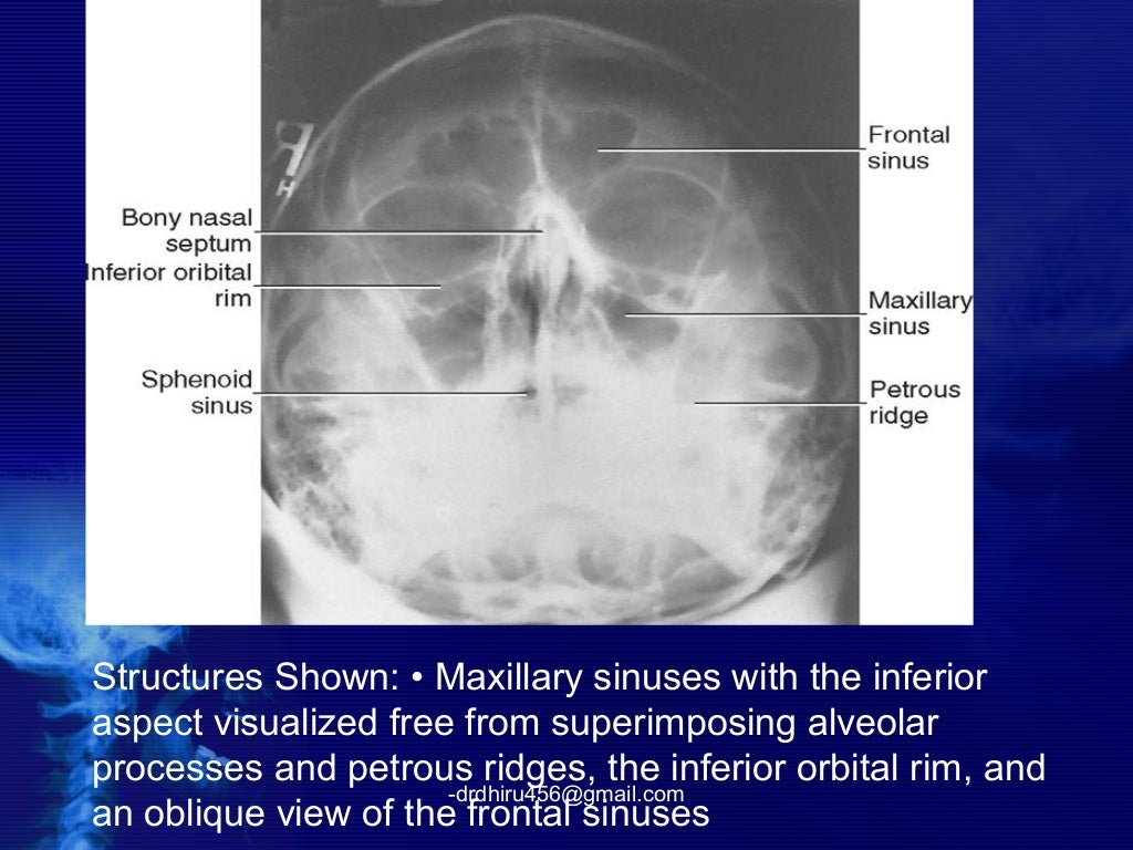 Radiology of nose and pns (by drdhiru456)