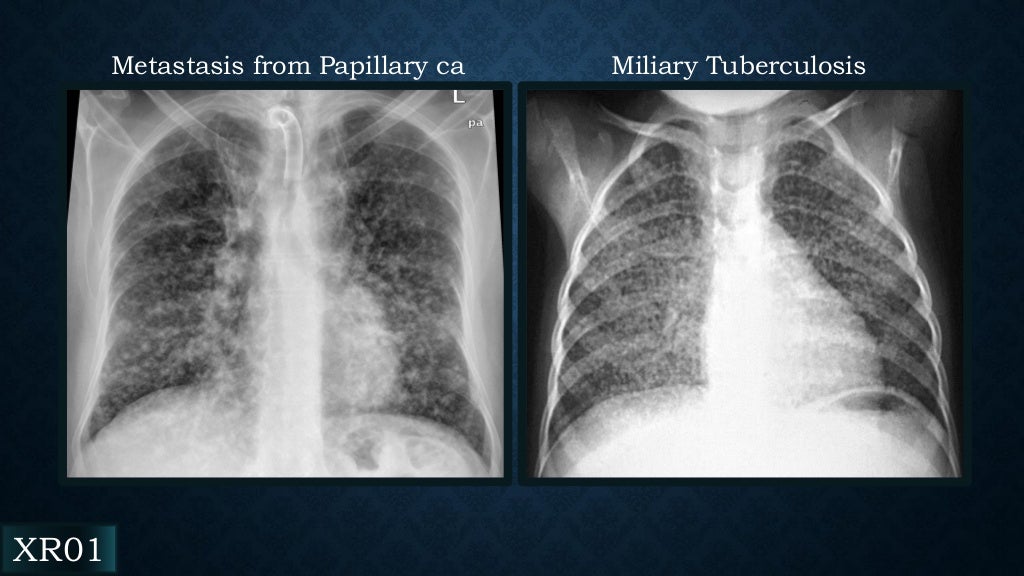 Radiology of Tuberculosis