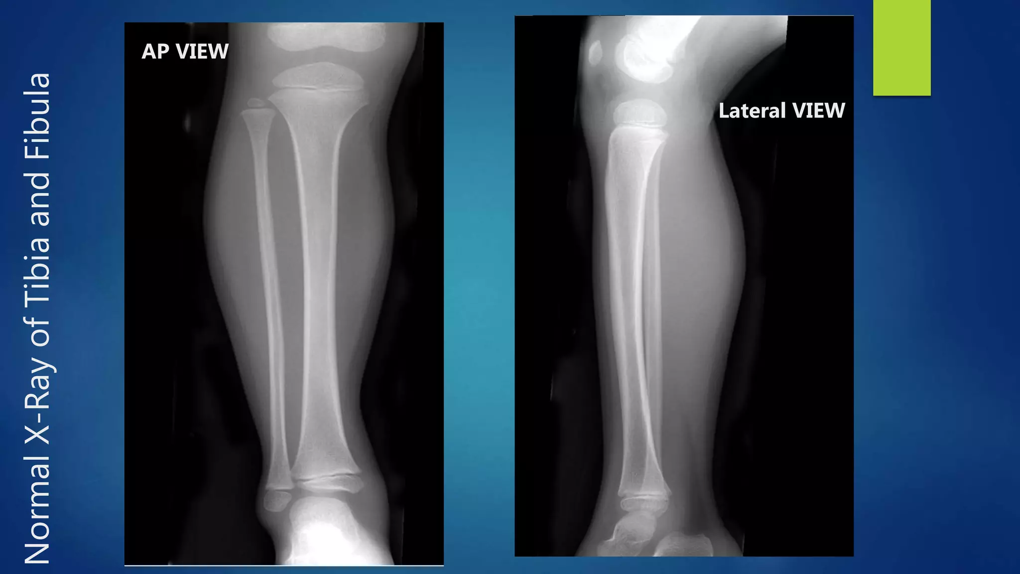 Radiology of the lower extremity dr asif ali khan | PPTX