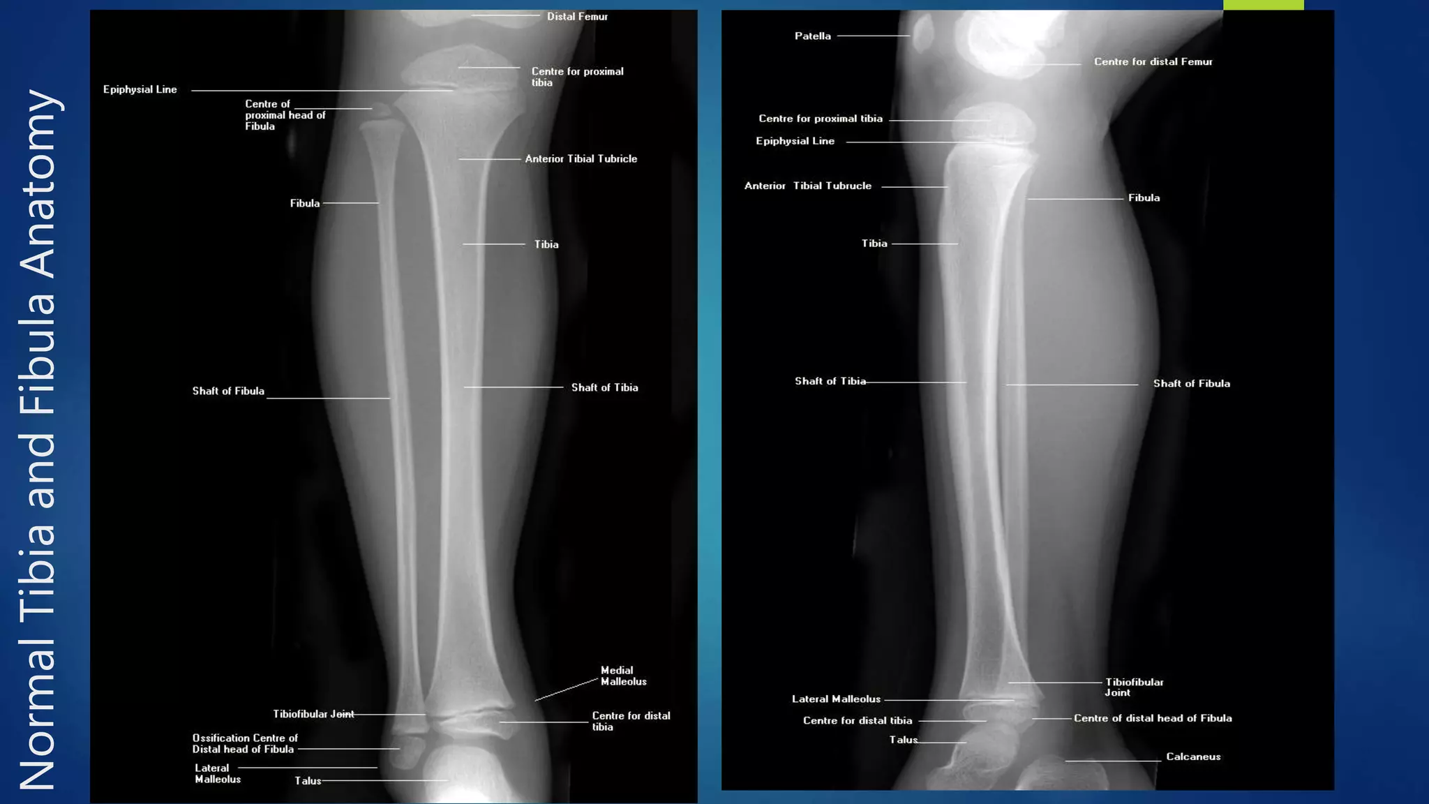 Radiology of the lower extremity dr asif ali khan | PPTX