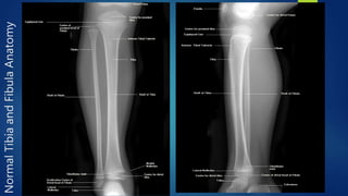 Tibia Normal Os Radiology of the lower extremity dr asif ali khan | PPTX
