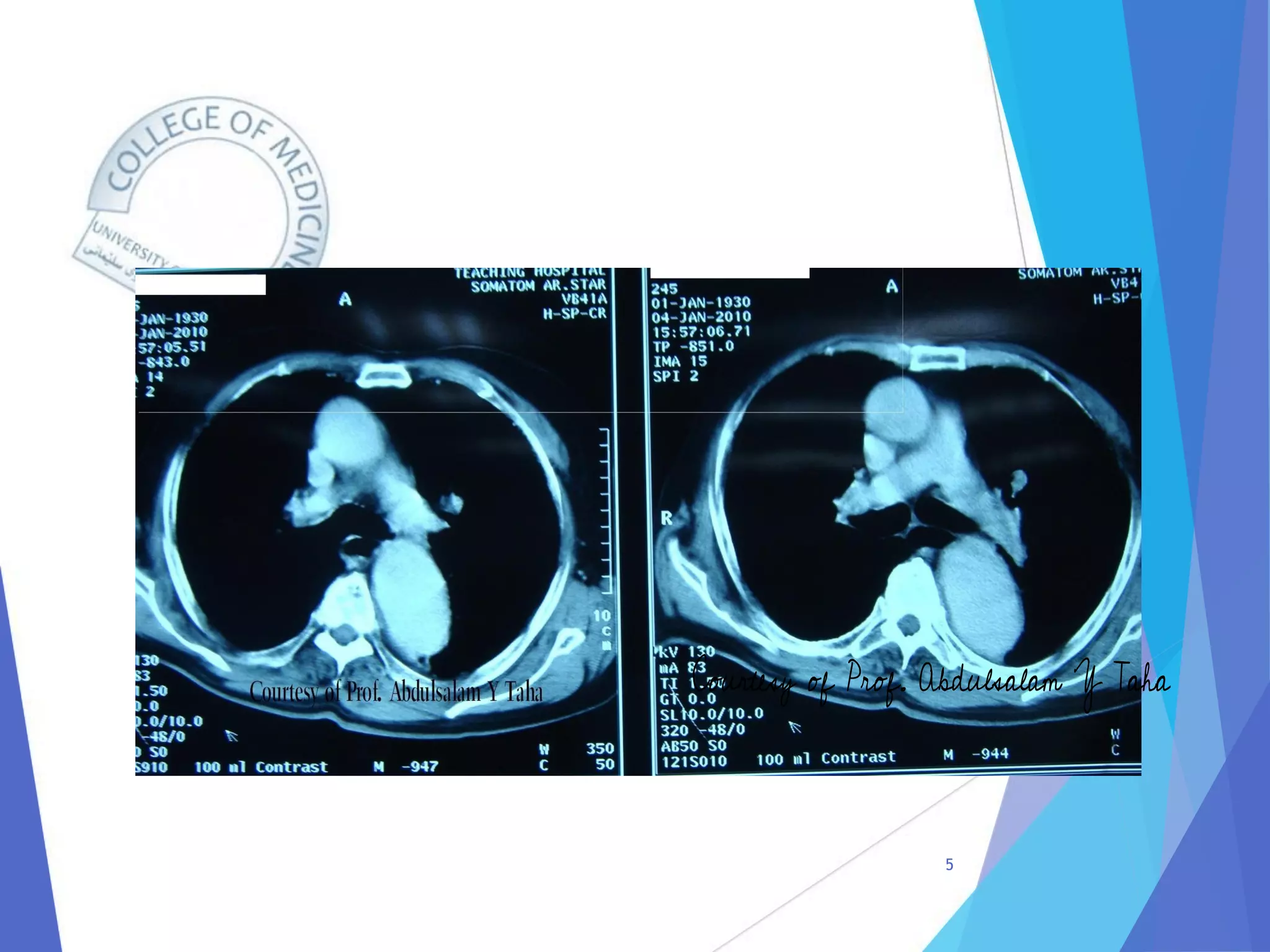 Radiology of Thoracic Aortic Aneurysms.pdf