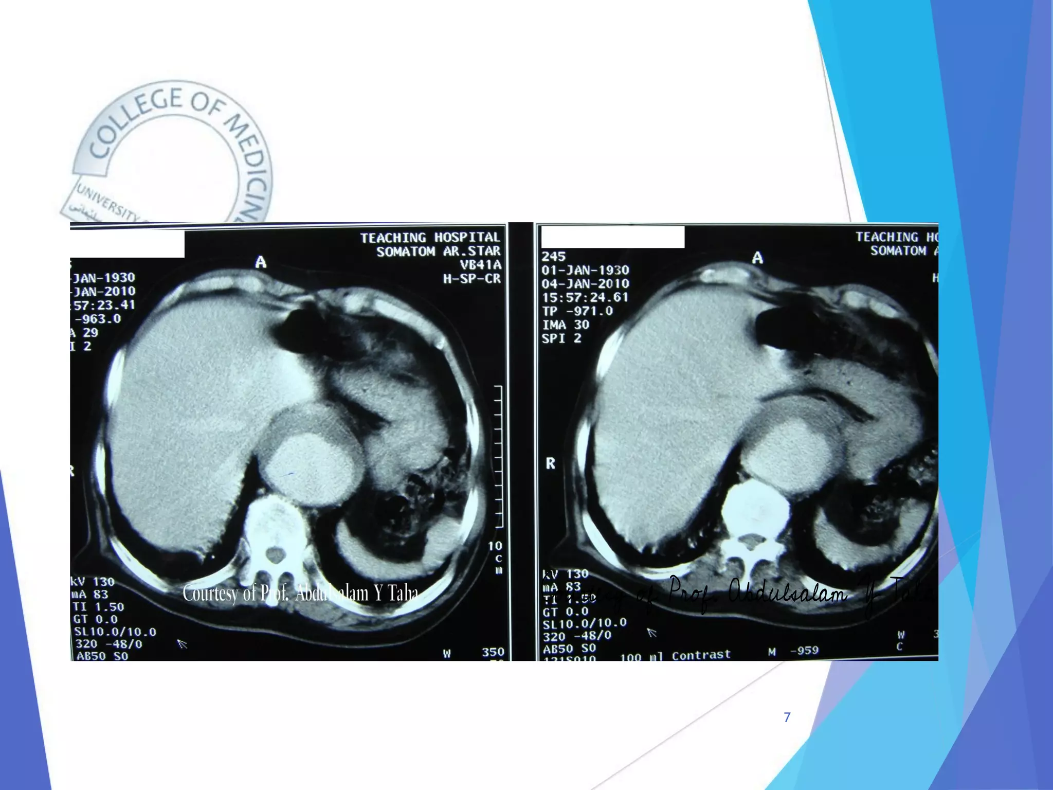 Radiology of Thoracic Aortic Aneurysms.pdf
