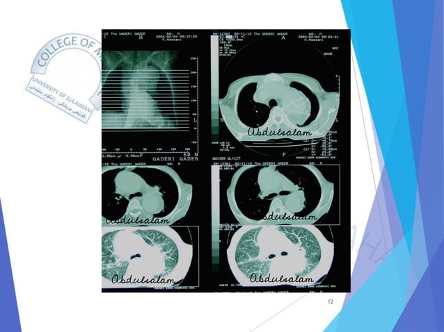 Radiology of Thoracic Aortic Aneurysms.pdf
