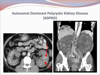 Radiology of urogenital systsm slide share | PPT