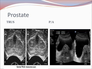 Trus Urology Example Radiology of urogenital systsm slide share | PPT