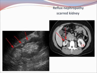 Radiology of urogenital systsm slide share Slide 43