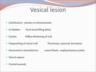 Radiology of urogenital systsm slide share Slide 53