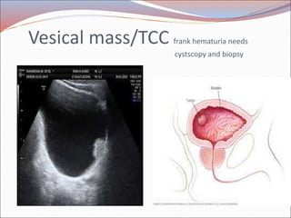 Radiology of urogenital systsm slide share Slide 58