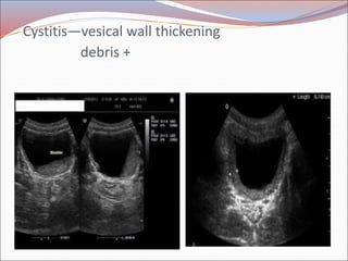 Radiology of urogenital systsm slide share Slide 60