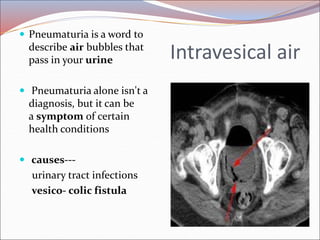 Radiology of urogenital systsm slide share Slide 67