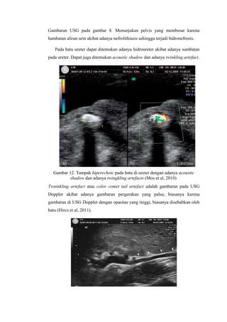 Gambaran USG pada gambar 8. Menunjukan pelvis yang membesar karena
hambatan aliran urin akibat adanya nefrolithiasis sehingga terjadi hidronefrosis.
Pada batu ureter dapat ditemukan adanya hidroureter akibat adanya sumbatan
pada ureter. Dapat juga ditemukan acoustic shadow dan adanya twinkling artefact.
Gambar 12. Tampak hiperechoic pada batu di ureter dengan adanya acoustic
shadow dan adanya twingkling artefacts (Mos et al, 2010)
Twninkling artefact atau color comet tail artefact adalah gambaran pada USG
Doppler akibat adanya gambaran pergerakan yang palsu, biasanya karena
gambaran di USG Doppler dengan opasitas yang tinggi, biasanya disebabkan oleh
batu (Hircs et al, 2011).
 