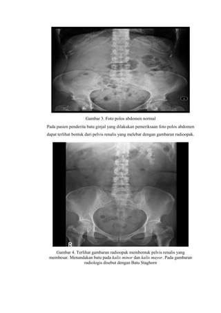 Gambar 3. Foto polos abdomen normal
Pada pasien penderita batu ginjal yang dilakukan pemeriksaan foto polos abdomen
dapat terlihat bentuk dari pelvis renalis yang melebar dengan gambaran radioopak.
Gambar 4. Terlihat gambaran radioopak membentuk pelvis renalis yang
membesar. Menandakan batu pada kalix minor dan kalix mayor. Pada gambaran
radiologis disebut dengan Batu Staghorn
 