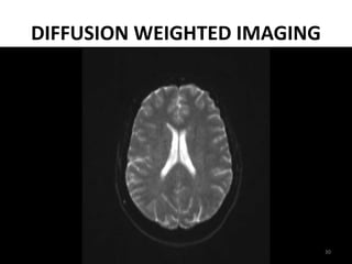 DIFFUSION WEIGHTED IMAGING
30
 