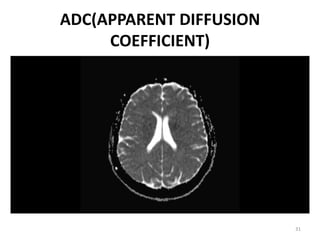 ADC(APPARENT DIFFUSION
COEFFICIENT)
31
 