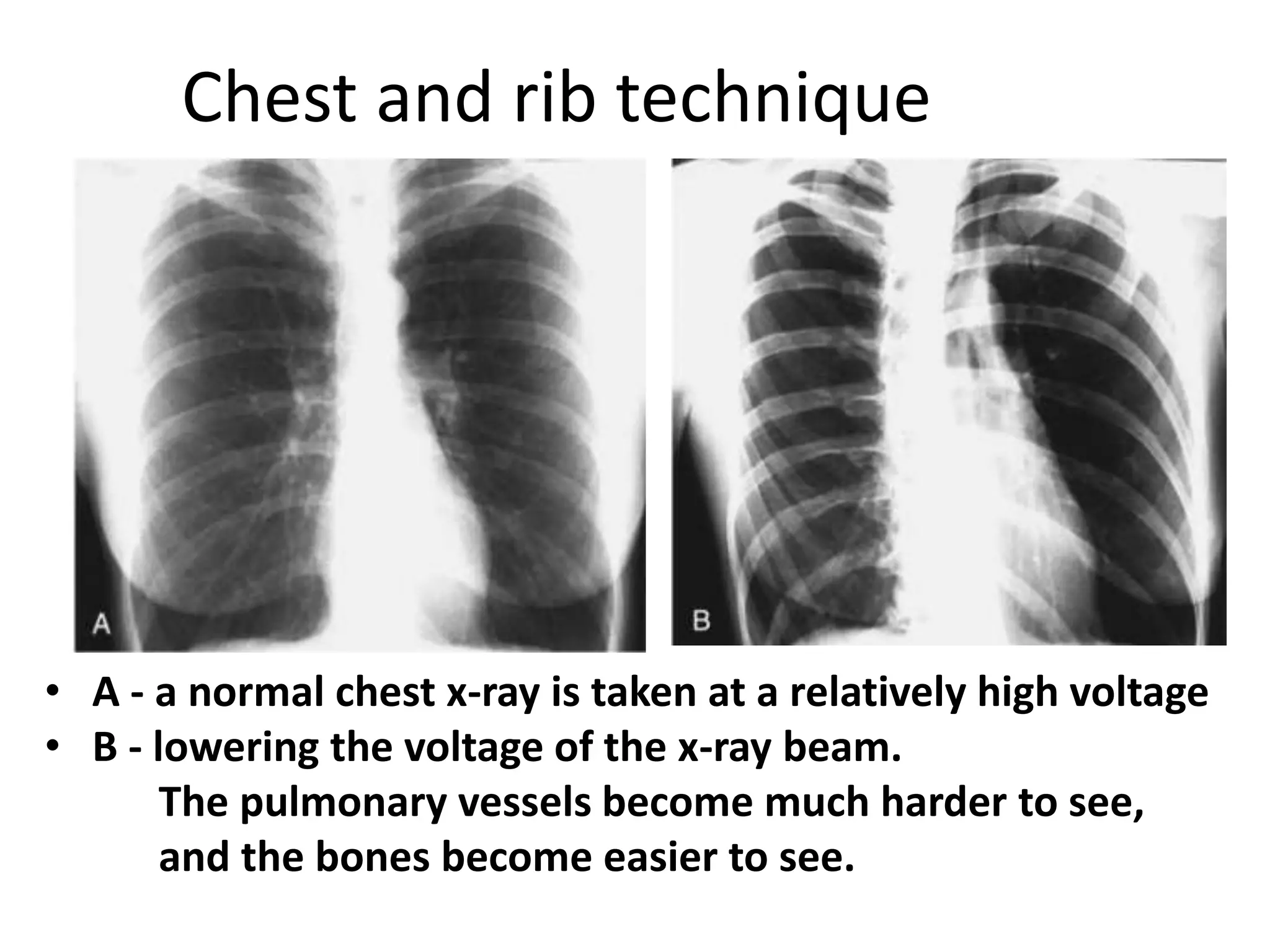 Chest and rib technique
• A - a normal chest x-ray is taken at a relatively high voltage
• B - lowering the voltage of the x-ray beam.
The pulmonary vessels become much harder to see,
and the bones become easier to see.
 