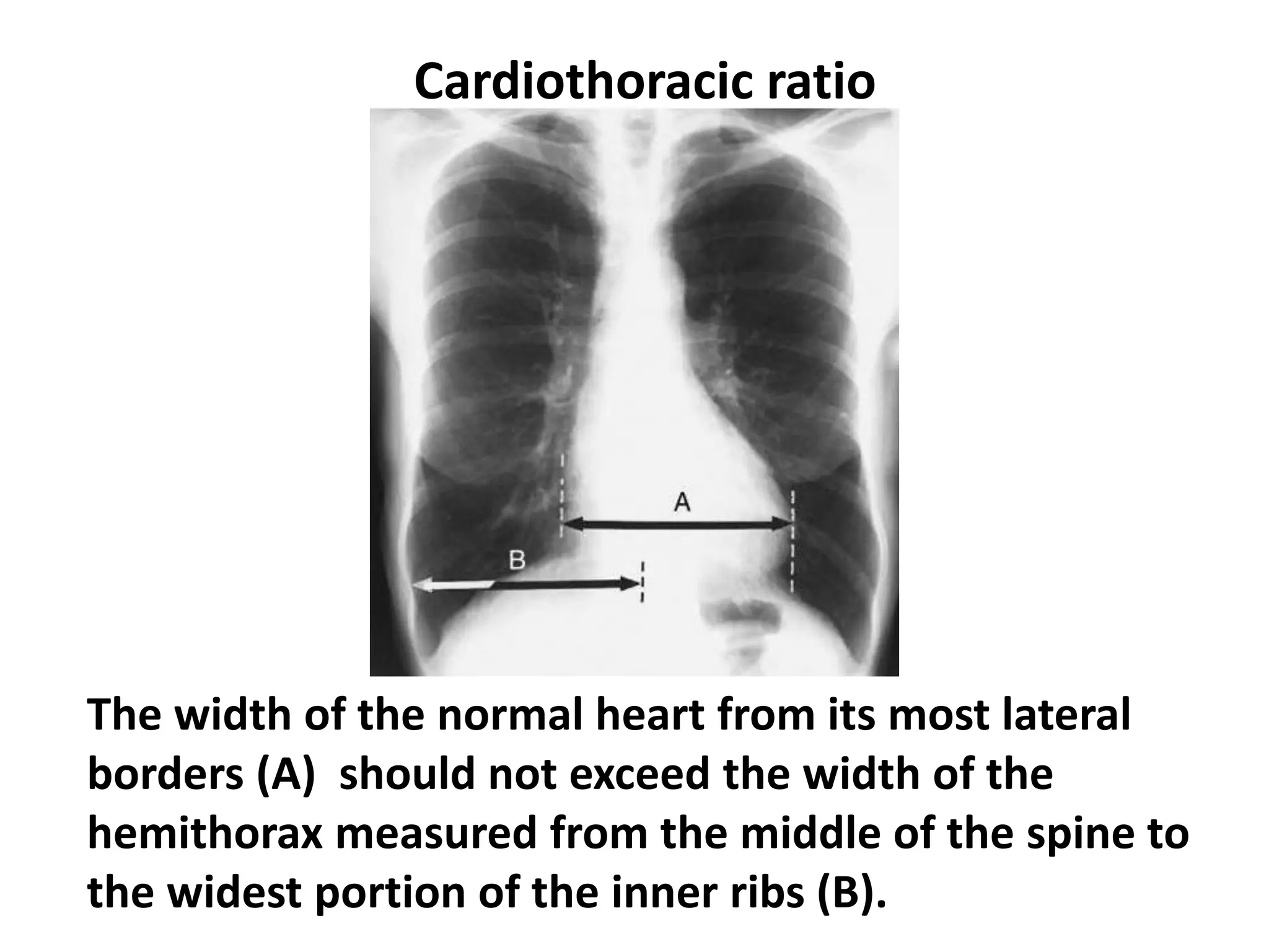 Cardiothoracic ratio
The width of the normal heart from its most lateral
borders (A) should not exceed the width of the
hemithorax measured from the middle of the spine to
the widest portion of the inner ribs (B).
 