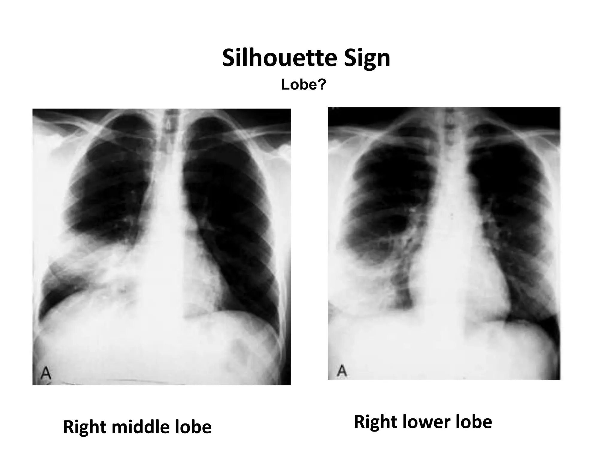 Silhouette Sign
Right middle lobe Right lower lobe
Lobe?
 