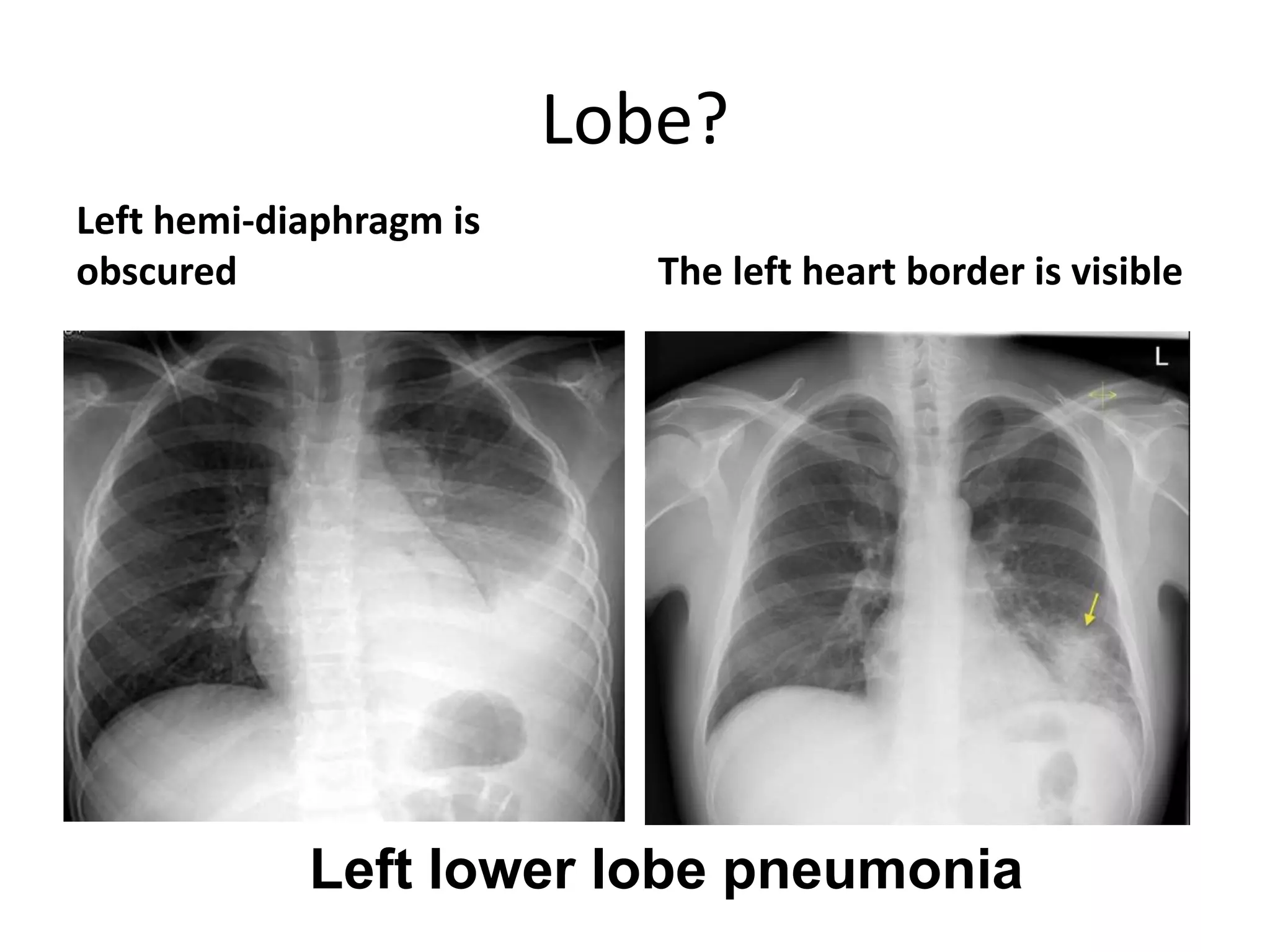 Lobe?
Left hemi-diaphragm is
obscured The left heart border is visible
Left lower lobe pneumonia
 